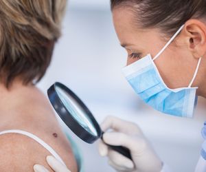 Dermatofibroma - przyczyny, objawy, leczenie