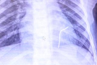 Drut przebił serce 5-letniego Przemka spod Opoczna