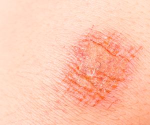 Choroba Bowena - przedinwazyjny RAK SKÓRY