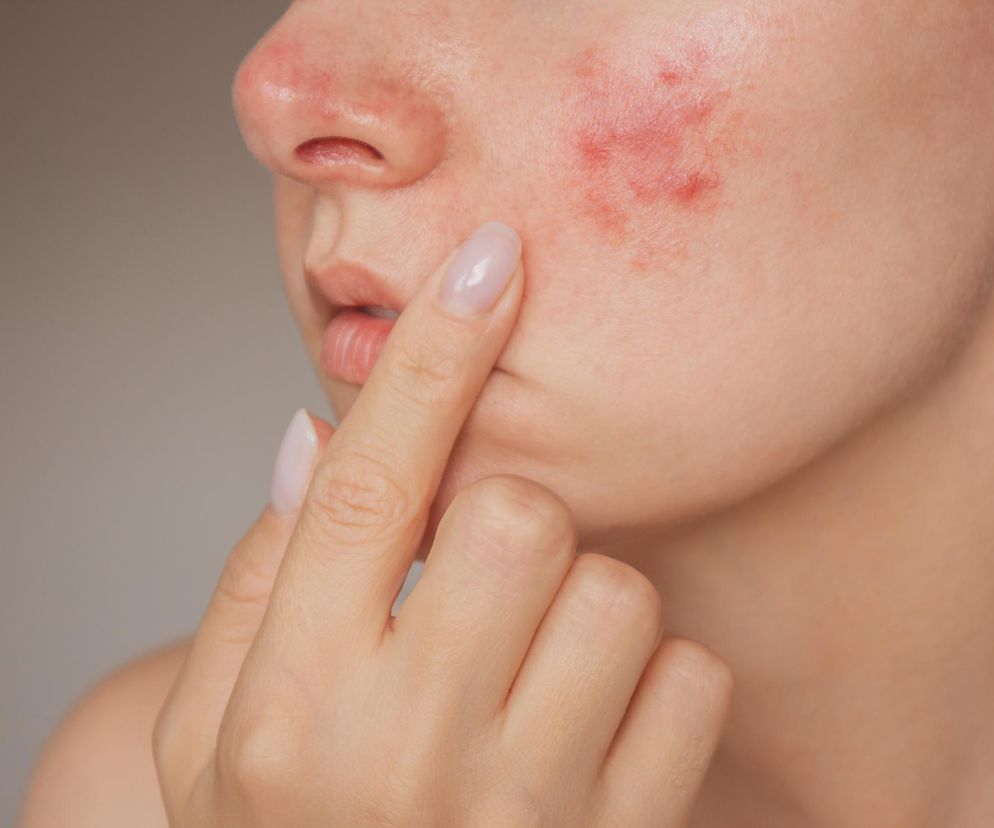 Problemy z wagą, cerą i płodnością to niejedyne skutki. Tak objawia się powszechne zaburzenie