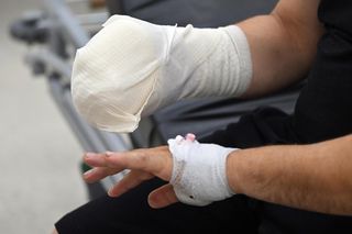 Lekarze z 5 Wojskowego Szpitala Klinicznego w Krakowie przyszyli oderwany kciuk panu Wojciechowi