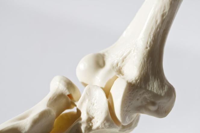 Osteoporoza czyli zrzeszotnienie kości