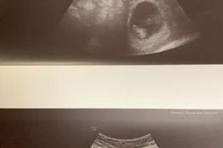 Wycięła dziecko z brzucha przyjaciółki! Matka i synek NIE ŻYJĄ