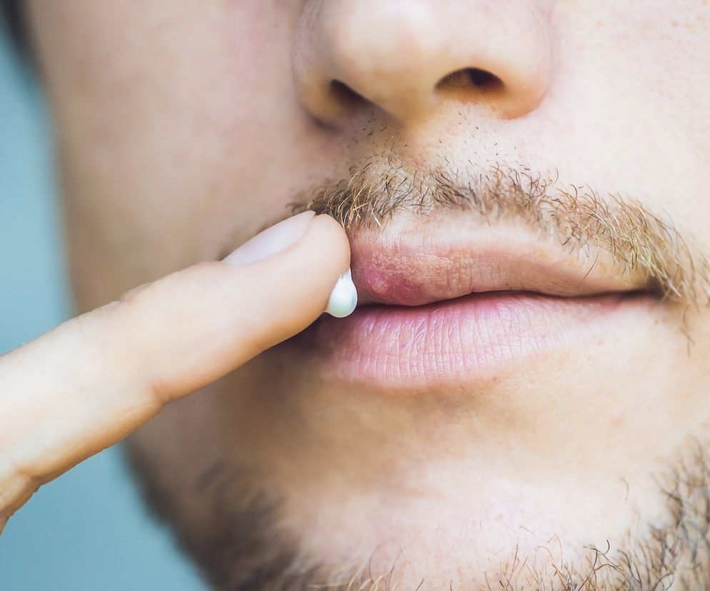 Nawracająca opryszczka – jak sobie z nią radzić?