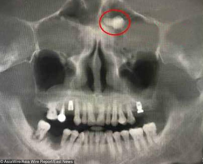 Wyrósł mu ząb pod okiem