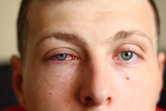 13 tys. przypadków jednego dnia. Narasta epidemia różowego oka