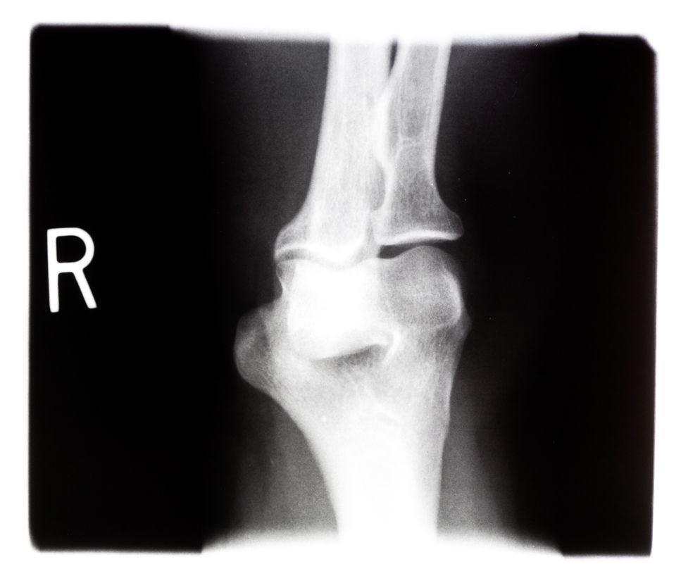 STAW RZEKOMY - objawy, leczenie, rehabilitacja