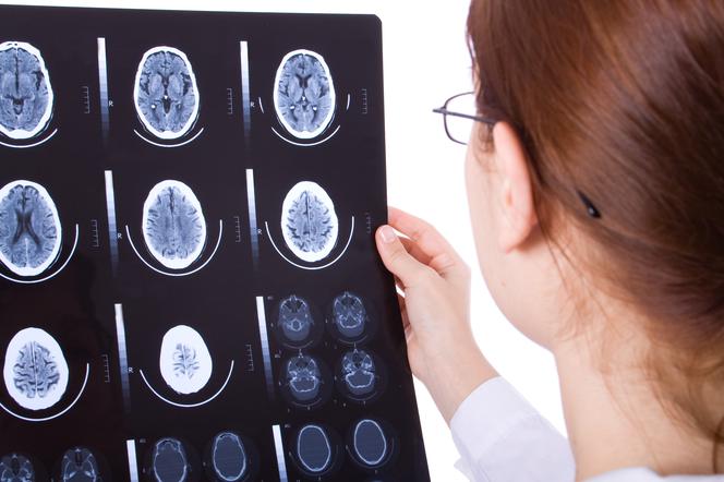 Tomografia komputerowa (TK, CT) mózgu - badanie RTG mózgu