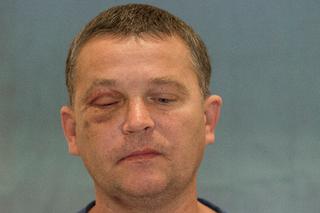 Wydrukowali mu nowe kości twarzy