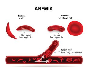 Niedokrwistość hemolityczna (anemia hemolityczna) - przyczyny, objawy, leczenie