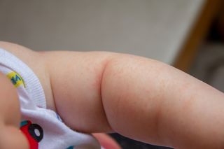 Po czym poznać, że niemowlę ma uczulenie na proszek do prania?