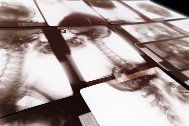 Nowotwory kości u dzieci i dorosłych - przyczyny, rodzaje i objawy