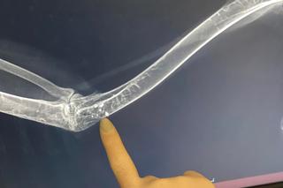 Myszołów Maciek trafił do Lecznicy po walce z innym ptakiem