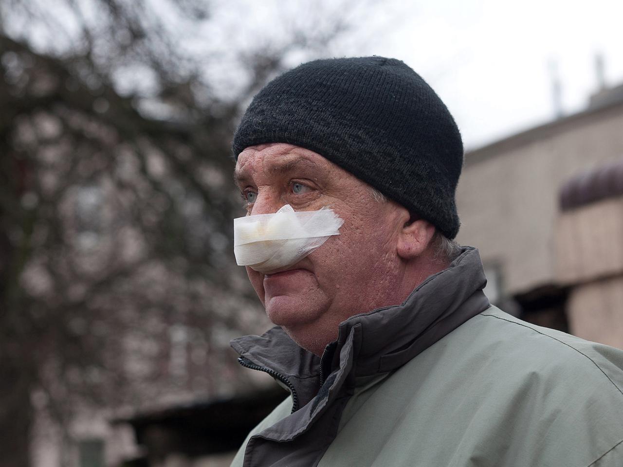 Kanibal odgryzł mi nos