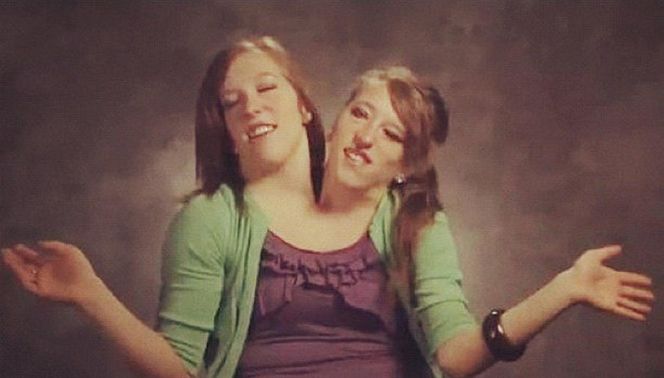 Siostry syjamskie urodziły dziecko?! Sensacyjne doniesienia