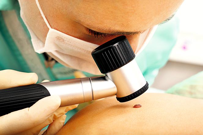 dermatoskopia