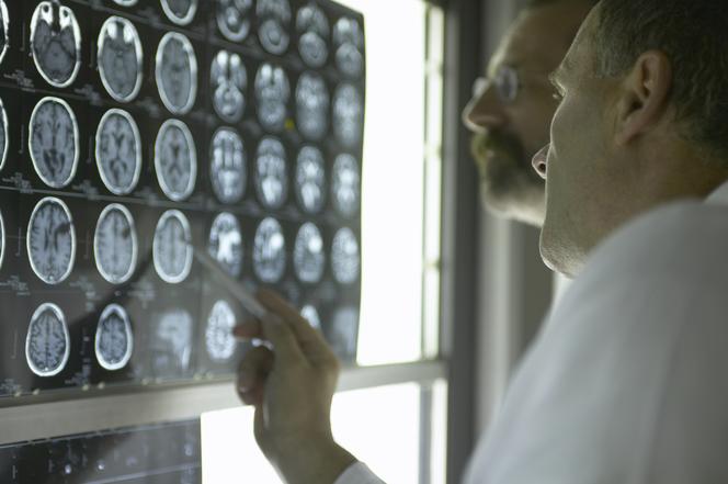 Poradnik Zdrowie: glejak: objawy i leczenie guza mózgu