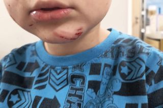 Pies pogryzł 4-letniego Frania. Chłopczyk w szpitalu, policja szuka właściciela