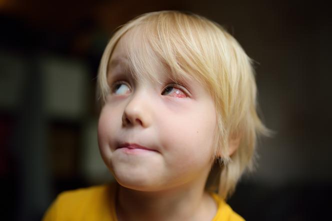 Zaczerwienione oko u dziecka - skąd siębierze i kiedy iść do lekarza?