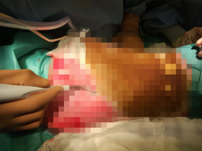 Przeżył piekło i 128 godzin operacji