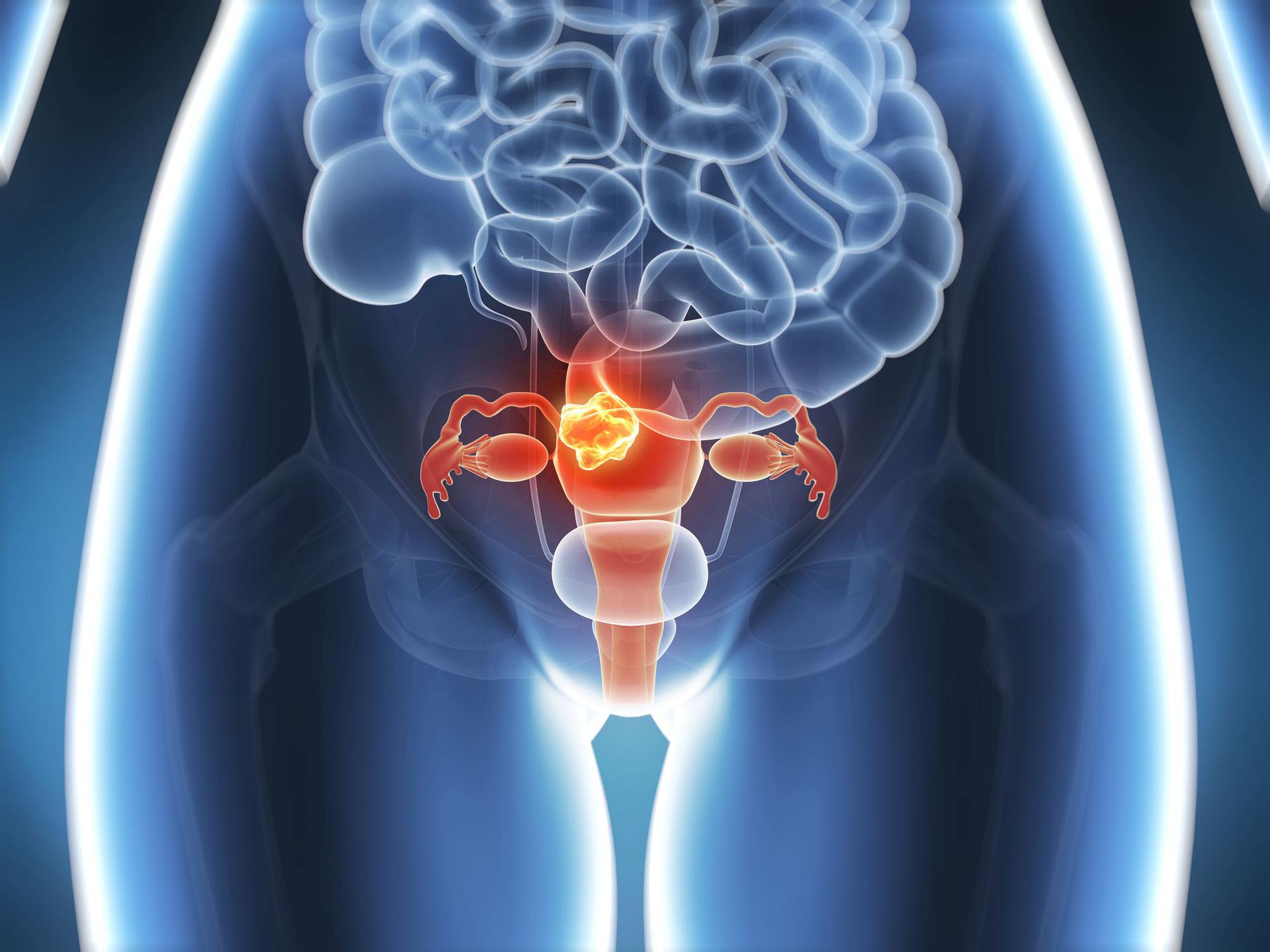 A méhdaganatokat is kiszűrheti a hüvelyi ultrahang, Endometrium rák a menopauza előtt