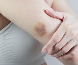 Siniaki: przyczyny i objawy. Na jakie choroby mogą wskazywać?