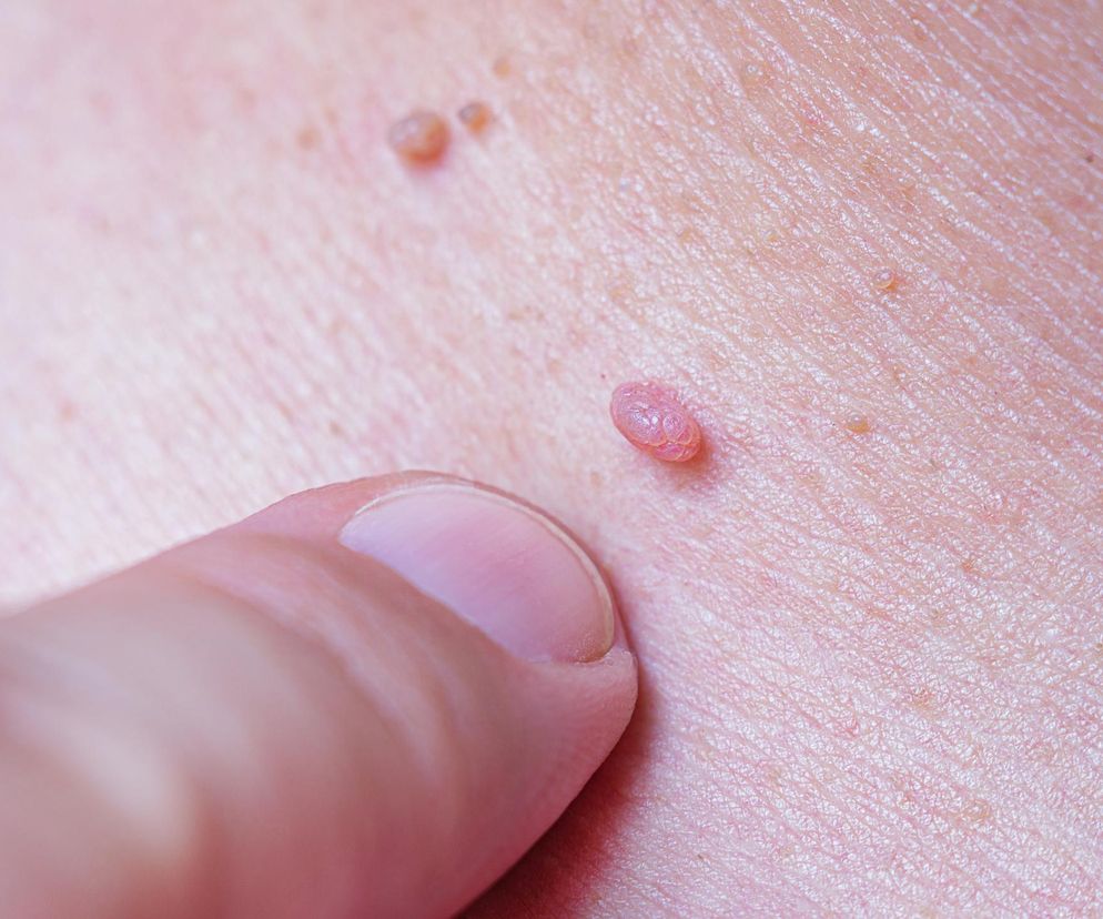 Palec dotyka skóry z widocznymi brodawkami i przebarwieniami, co podkreśla konieczność regularnych badań w kontekście zapobiegania rakowi skóry. O objawach i profilaktyce dowiesz się więcej na portalu Poradnik Zdrowie.
