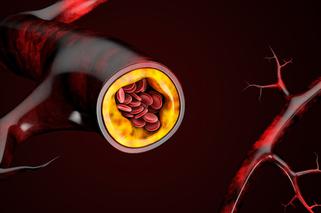Cholesterol LDL - czym jest? Badanie i normy