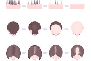 Wypadanie włosów u dzieci: dlaczego dzieci łysieją? Przyczyny, objawy, leczenie