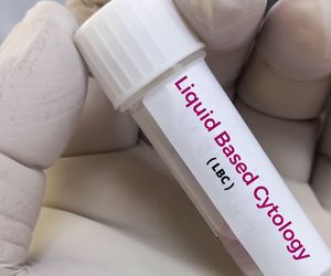Cytologia płynna - nowoczesna technika diagnostyki raka szyjki macicy