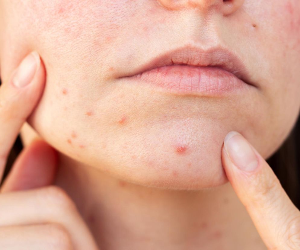 Jak organizm ostrzega przed nadmiarem kortyzolu? 10 wyraźnych sygnałów