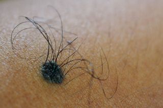 Znamię Beckera: definicja, obraz kliniczny, rozpoznanie, różnicowanie, leczenie