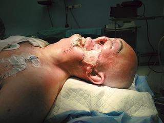 przeszczep twarzy pacjent wyszedl do domu (2)