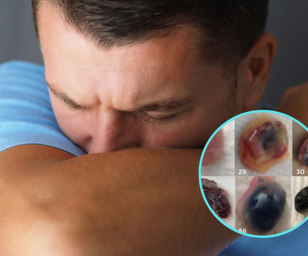 Naukowcy odkryli, że wraz z wiekiem czernieją węzły chłonne płuc osób, które oddychają zanieczyszczonym powietrzem