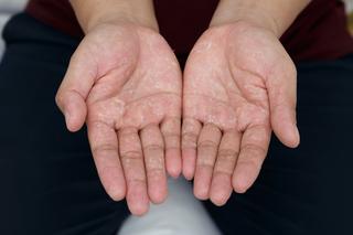Zimne dłonie, swędzenie nadgarstków, kreski na paznokciach. O czym świadczą dolegliwości dłoni i rąk?