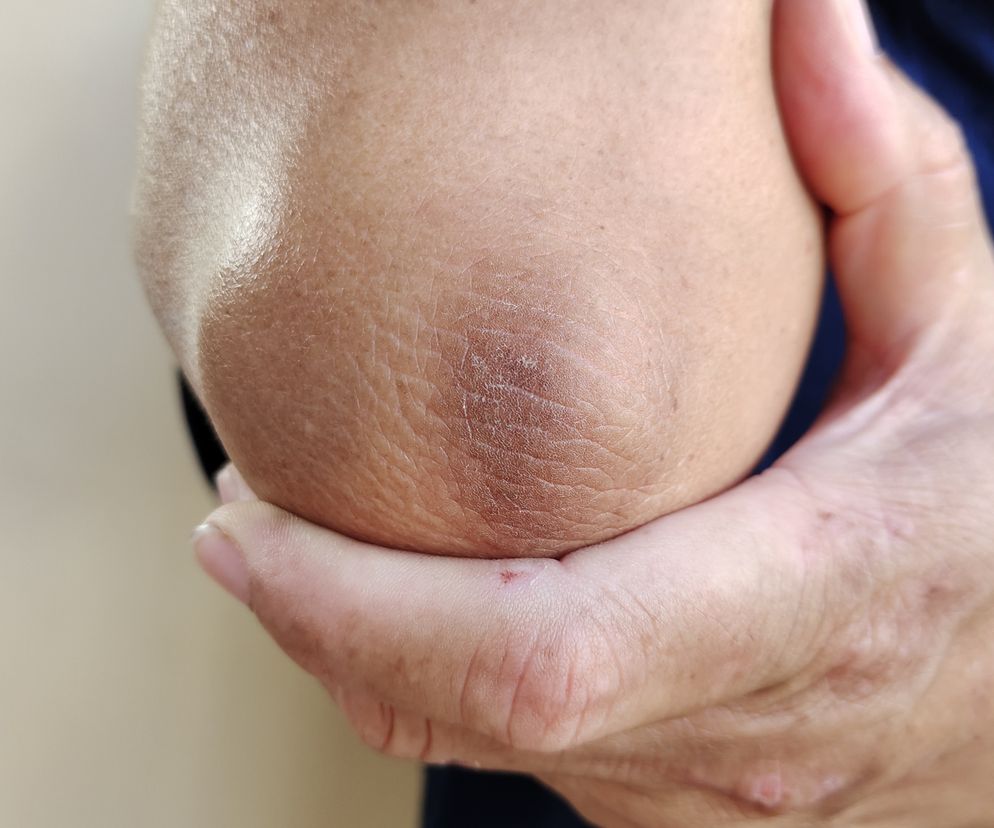 Przykładowe zmiany na skórze świadczące o stanie przedcukrzycowym