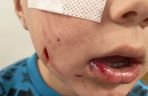 Pies pogryzł 4-letniego Frania. Chłopczyk w szpitalu, policja szuka właściciela