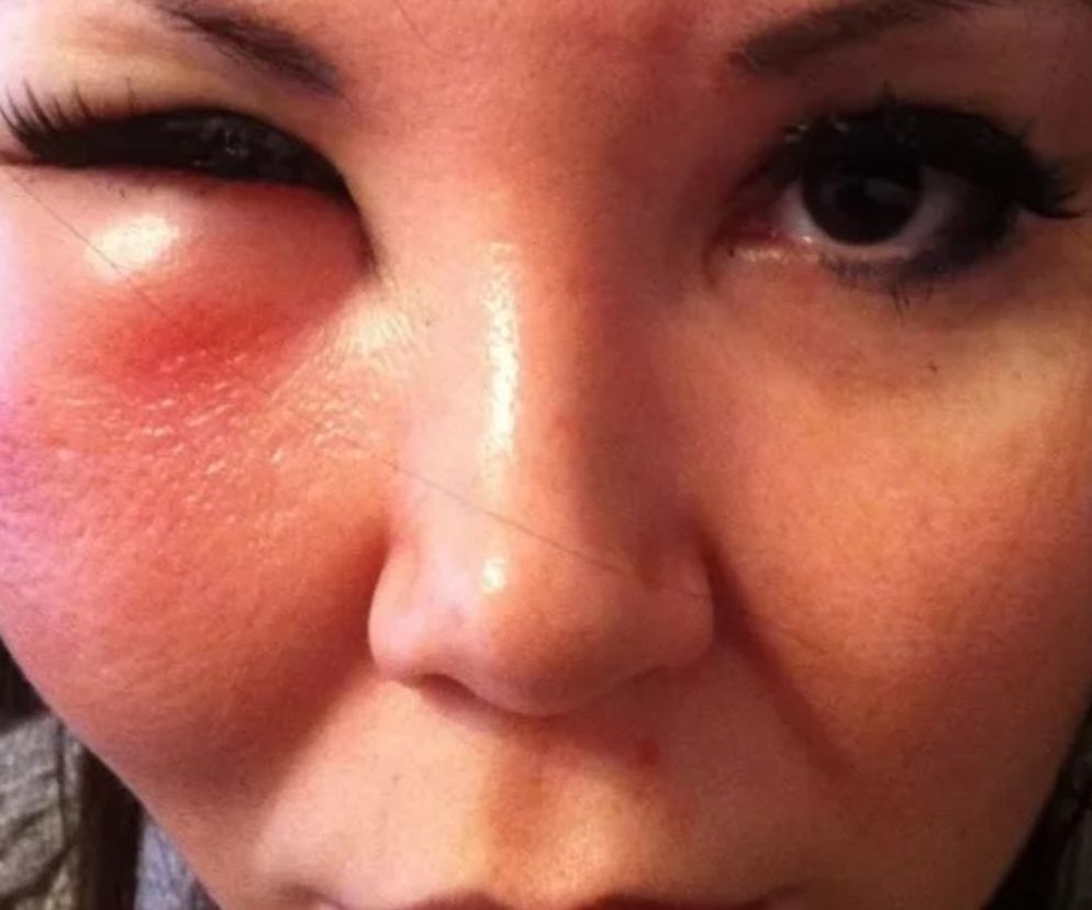 Powikłania ujawniły się 4 lata po zabiegu. Chciała wyglądać młodziej, teraz ma zdeformowaną twarz 