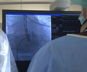 Krioablacja - metoda leczenia migotania przedsionków