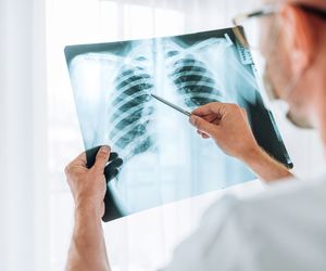 Zator płucny wymaga jak najszybszej interwencji. Poznaj jego objawy i przyczyny