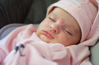 Uszczypnięcie bociana - jak wygląda to znamię i czy jest groźne dla niemowlęcia?