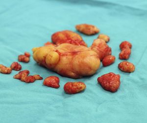 Choroba Dercuma: przyczyny, objawy i leczenie podskórnych tłuszczaków