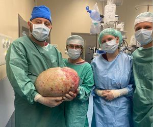 Ważył 20 kilogramów. Kobieta nosiła go w sobie przez dłuższy czas
