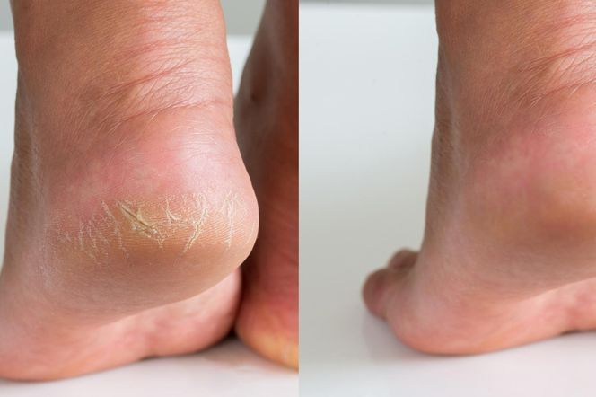 Wieczorem wsmaruj 2 łyżki w suche pięty i zmyj po 5 minutach. Będą miękkie i gładkie jak u niemowlęcia. Sposób na suche pięty