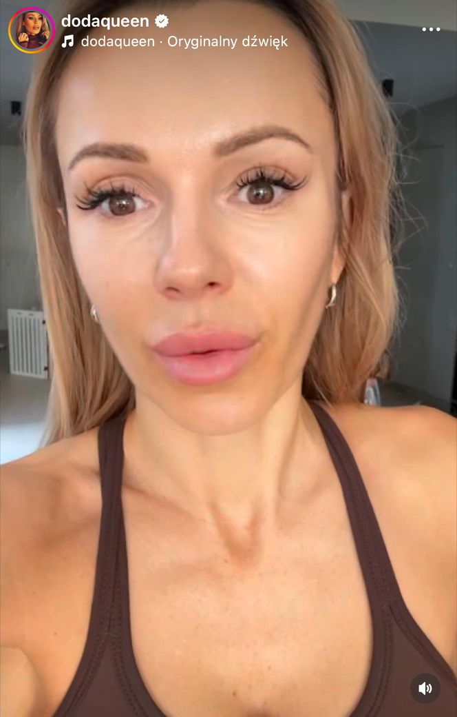 Doda pokazała bliznę po wycięciu czerniaka