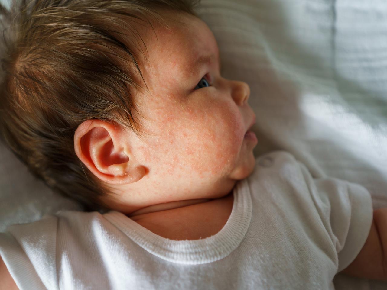 Alergia skórna - jak objawia się alergia skórna u dziecka i jak się ją leczy?