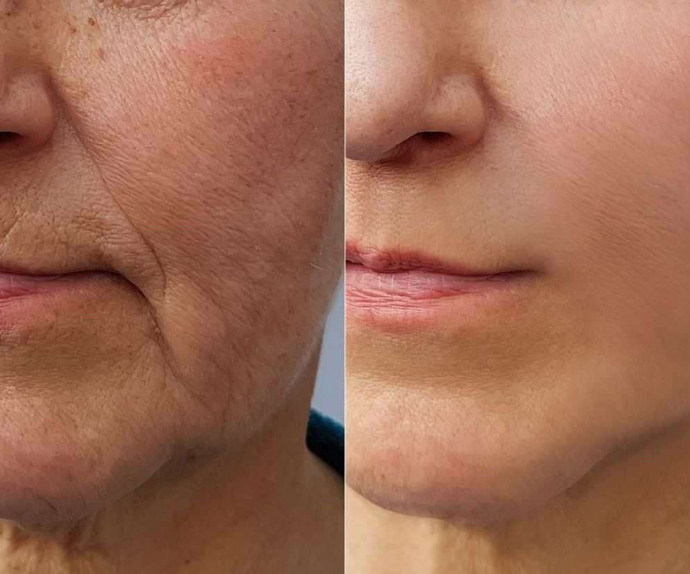 Prasuje zmarszczki niczym żelazko. Weź 7 zł i pędź do apteki