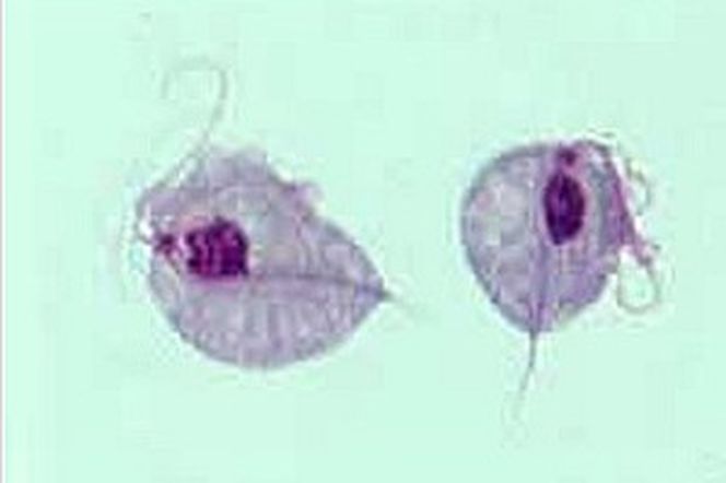Rzęsistek pochwowy - objawy zakażenia, leczenie, powikłania