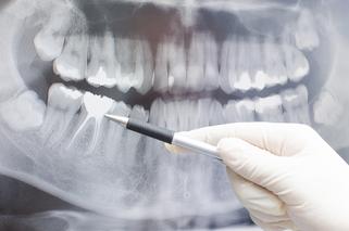 Rentgen (RTG) zębów - badanie radiologiczne zębów