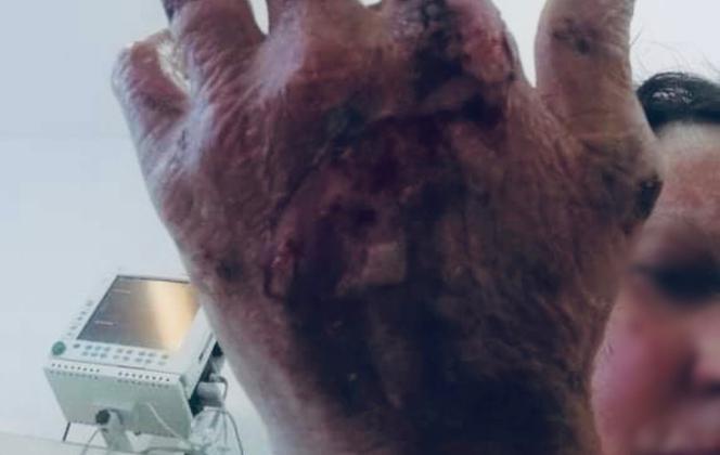 Dramat rodziny po wybuchu gazu. Ciężko poparzone dzieci. " Łzy na naszych policzkach płyną nieustannie" [DRASTYCZNE ZDJĘCIA]